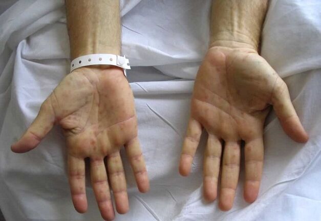 Syphilis on the hands as a cause of the pathological discharge of the penis